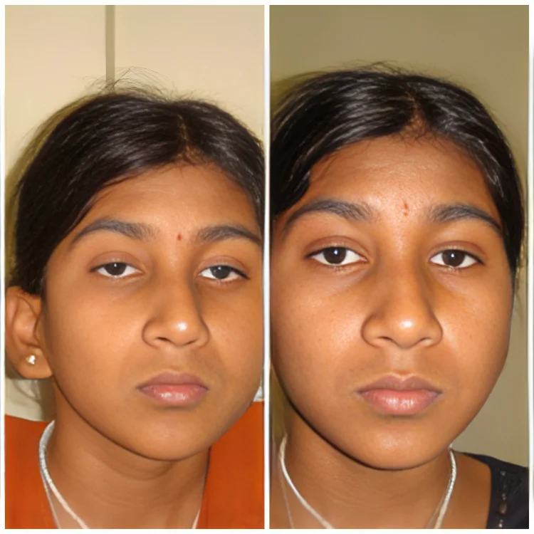 Oculoplasty-7